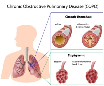 management of chronic obstructive pulmonary disease exacerbations acute bronchitis